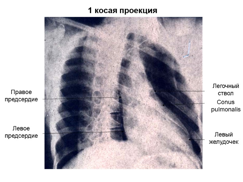 Правое предсердие Левое  предсердие Легочный ствол Conus pulmonalis Левый желудочек 1 косая проекция